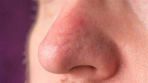 What Is Alcoholic Nose (Rhinophyma)? | Red Drinker's Nose