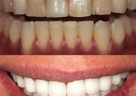 Composite Veneers Pros And Cons