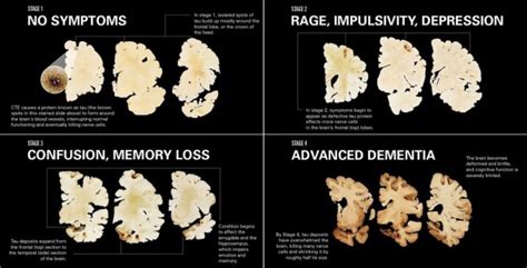 Chronic Traumatic Encephalopathy, a killer disease | SiOWfa16: Science in Our World: Certainty ...