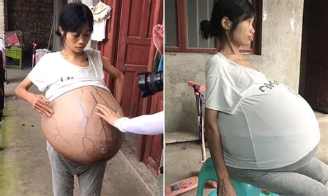 Chinese woman's belly grows to 44lbs due to mystery condition | Daily Mail Online