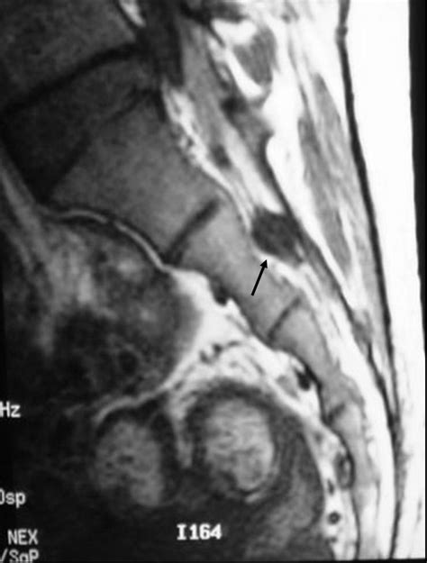 MRI MEDIC CASE STUDIES COLLECTION: TARLOV CYST