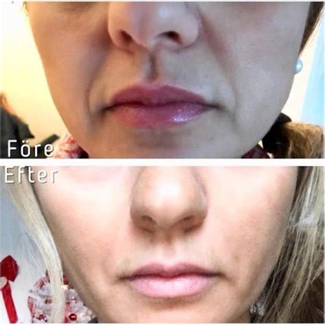 Juvederm Before And After Photos Nasolabial Folds (7) » Facial Injections: Info, Prices, Photos ...