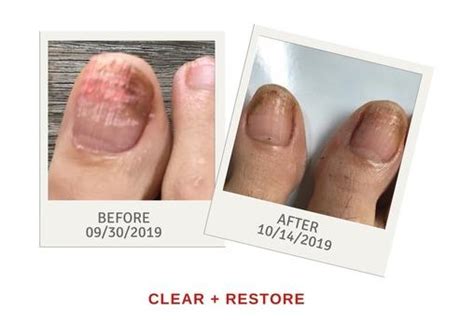 Hydrogen Peroxide Toenail Fungus Before And After - lvandcola