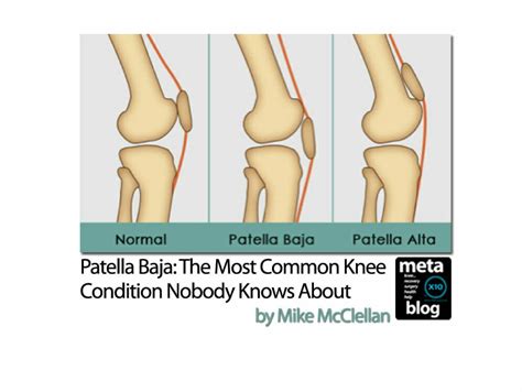 Patella Baja: The Most Common Knee Condition Nobody Knows About