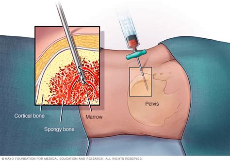 Research Advances: Mobilized Stem Cells vs Bone Marrow Stem Cells | Seattle, WA Patch