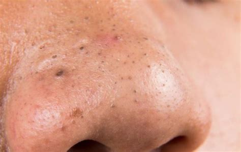 Blackheads Meaning, Formation, Causes and Treatment - Skincarederm