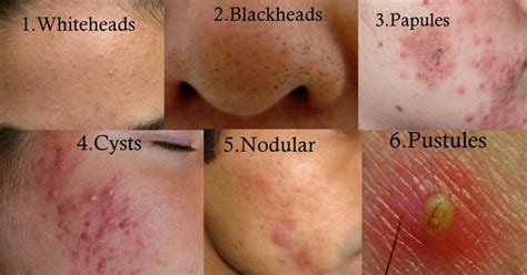 Types of Acne | Back acne treatment, Diy acne treatment, Cystic acne ...