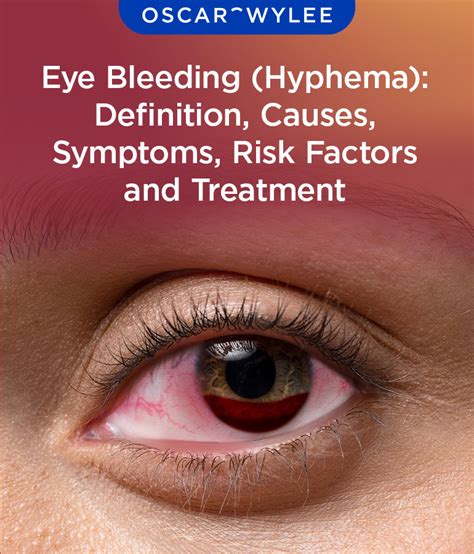 Eye Bleeding (Hyphema): Definition, Causes, Symptoms, Risk Factor and Treatment