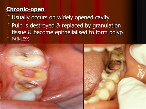 PPT - PULPITIS Inflammation of dental pulp Main source for dental pain ...