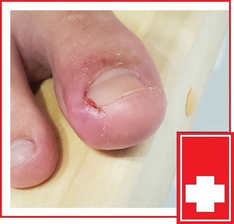 Ingrown Toenail Removal/Treatments | Ingrown Toenail Specialist Near Me | Wilmington Urgent Care ...