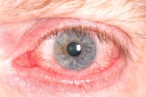 Eye Redness: Causes, Symptoms & Complications