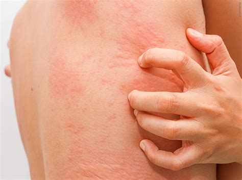 Urticaria - Causes, Symptoms, Treatment, Home Remedies