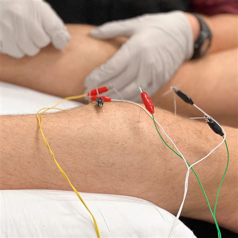 How Dry Needling Therapy Can Help Chronic Pain – MS Physical Therapy