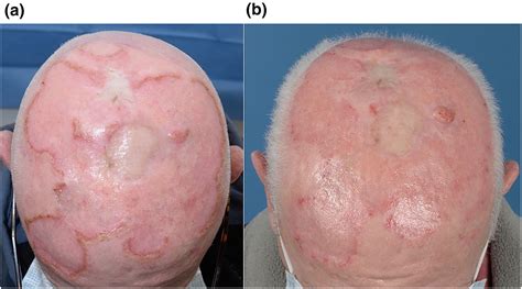 Serratia marcescens causing recurrent superficial skin infections in an immunosuppressed patient ...