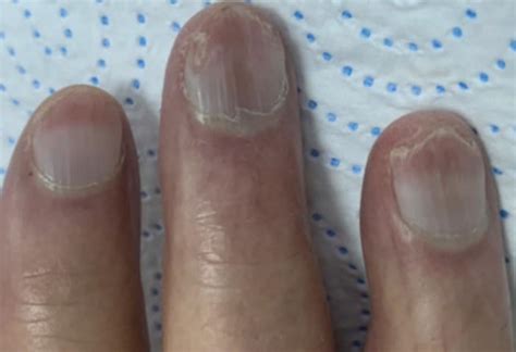 Lindsay nails • LITFL • Medical Eponym Library