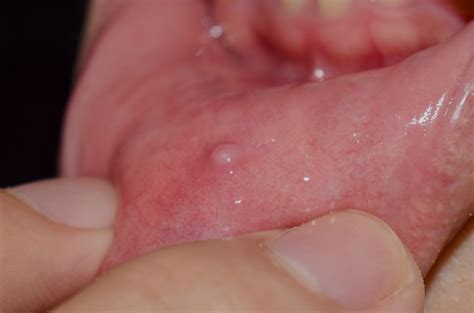 Mucocele (Mucous Cyst) Types, Symptoms, Causes, Diagnosis, & Treatment At blog.cult.fit