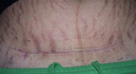 Caesarean Scar Pictures