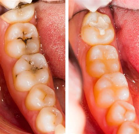 Choosing a Tooth Filling: Silver vs. White Fillings, What to Know