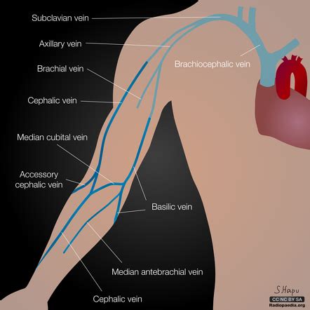 Basilic vein | Radiology Reference Article | Radiopaedia.org