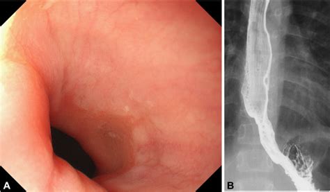 Peroral endoscopic myotomy for a pediatric case of suspected congenital ...