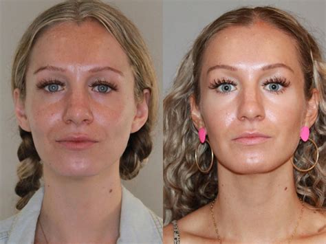 Sculptra® Aesthetic in Atlanta | Buckhead Facial Plastic Surgery