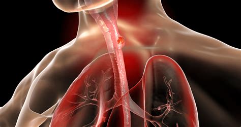 Immunotherapy is now the first choice for esophageal cancer - Archyde