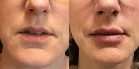 Restylane Kysse Lip Filler Before & After Photos New Jersey - Reflections Center