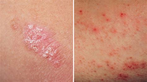 Eczema vs. Psoriasis