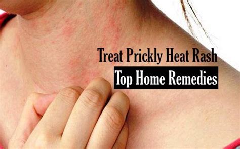 Heat Rash Pictures Treatment Causes Types Symptoms Prevention - Riset