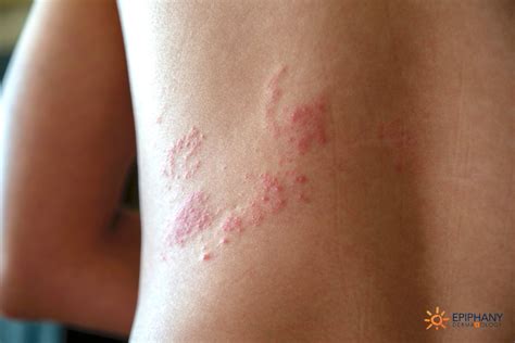 Shingles on the back: How to identify and other causes, rash on bra line - plantecuador.com