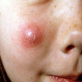Site is a good reference/:-) links to Simple Ways to Treat Skin Abscess | Home remedies for skin ...