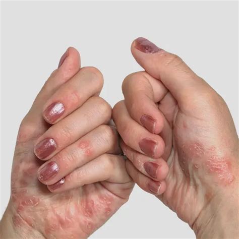 What Does Psoriasis Look Like on Your Hand?