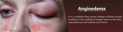 Angioedema - Causes, Symptoms, Diagnosis & Treatment