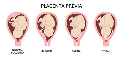 7,941 BEST Placenta IMAGES, STOCK PHOTOS & VECTORS | Adobe Stock