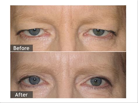 Eyelid Diseases and Disorders – Dr. Bhange Eye Hospital