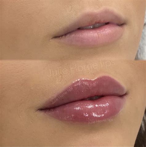 Pin by Zuzanna Bojdzinska on Lip fillers | Botox lips, Lip fillers ...