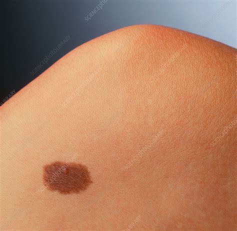 Pigmented naevus (benign mole) on a woman's knee - Stock Image - M220/0075 - Science Photo Library