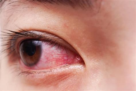 Red Eyes Symptoms | ferraz.com.br