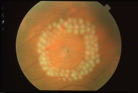 Learn About Retinal Tear Treatment Options in Sarasota