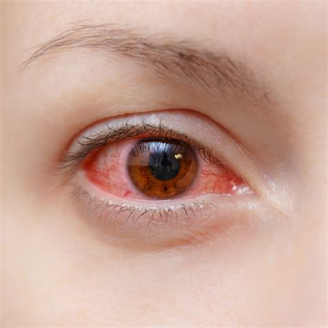 Dry Eye vs. Eye Allergies - Monterey, CA - Salinas - King City