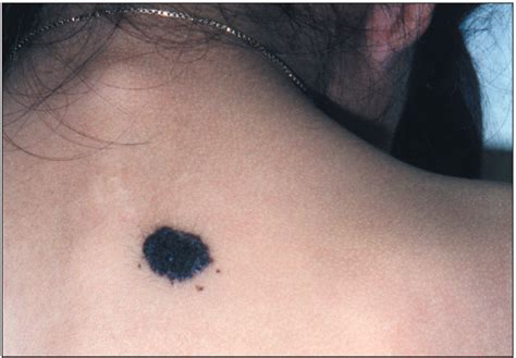 Photoclinic: Congenital Melanocytic Nevus | Consultant360