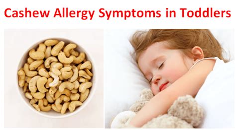 Cashew Allergy Symptoms in Toddlers - Fruits Facts