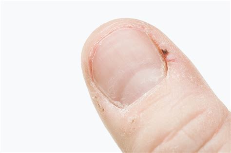 The Five Most Effective Home Remedies For Hangnails | Footfiles