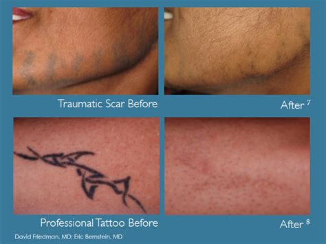 PicoWay professional laser removal - Removable Regrets