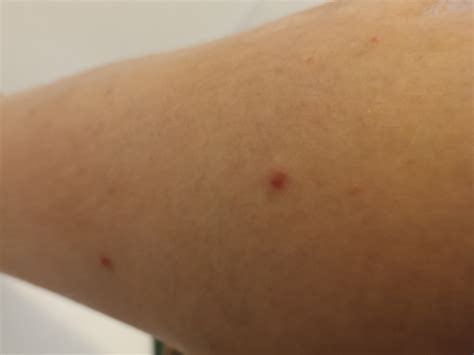 Red spots on legs and arms : r/DermatologyQuestions