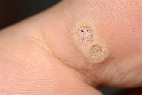 How To Keep Warts From Coming Back - Theatrecouple12