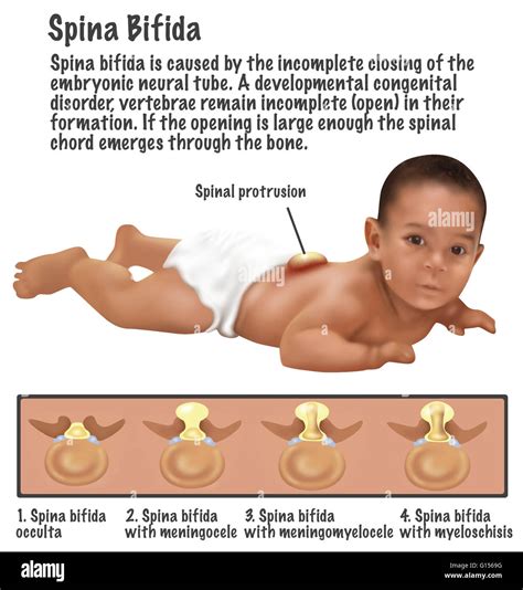 An illustration of a baby with Spina Bifida. Spina bifida is caused by ...