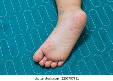 Enterovirus Leg Arm Mouth Rash On Stock Photo 2203757931 | Shutterstock