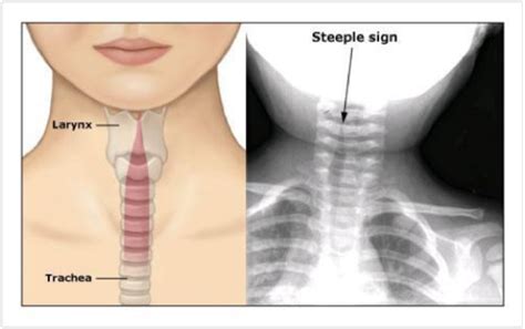 Comparison between Croup, Epiglottitis and Tracheitis – RCEMLearning India