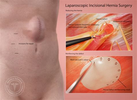 Incisional Hernia Repair near Pasadena and Los Angeles CA